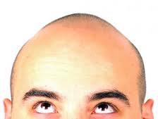 balding